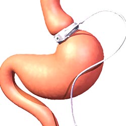 Laparoscopic Gastric Banding, also known as Lap Band, is a weight loss surgery option for obese patients who have been unable to lose weight using conventional methods.