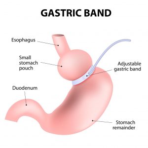 Weight Loss Surgery Types for Severe Obesity