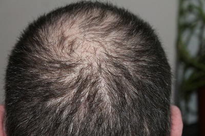 The Relationship Between Weight Loss and Hair Loss